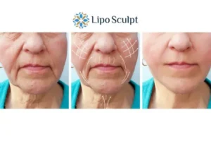 Explaining Morpheus8 And What It Can Do For You 3 Boost your confidence with Morpheus8 Waltham Cross call our team today!