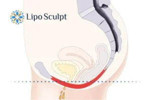Pelvic Floor Chair Therapy 1 Pelvic Floor Chair Therapy Waltham Cross to treat incontinence.