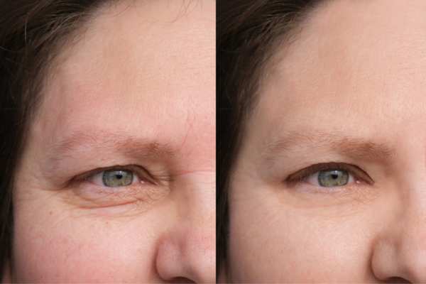 HIFU vs Botulinum Toxin: Understanding the Differences 4 How long do HIFU results last Waltham Cross?